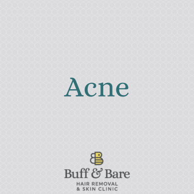 Acne. Acne Treatment services from Buff & Bare in St Albans
